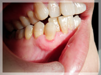 術後、付着歯肉が増え歯肉の厚みが厚くなり強靭な状態になっている