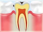 C1 【エナメル質の虫歯】