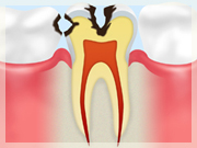 C2 【象牙質の虫歯】