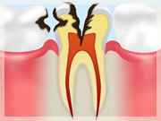 C3 【神経まで達した虫歯】