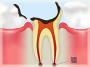 C4 【歯根まで達した虫歯】