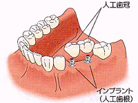 インプラント治療