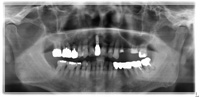 術後（パノラマ）