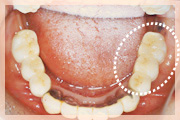 術後（下顎）