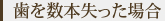 歯を数本失った場合